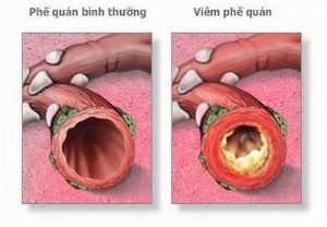 Viêm phế quản